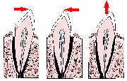После удаления зуба производится ревизия лунки